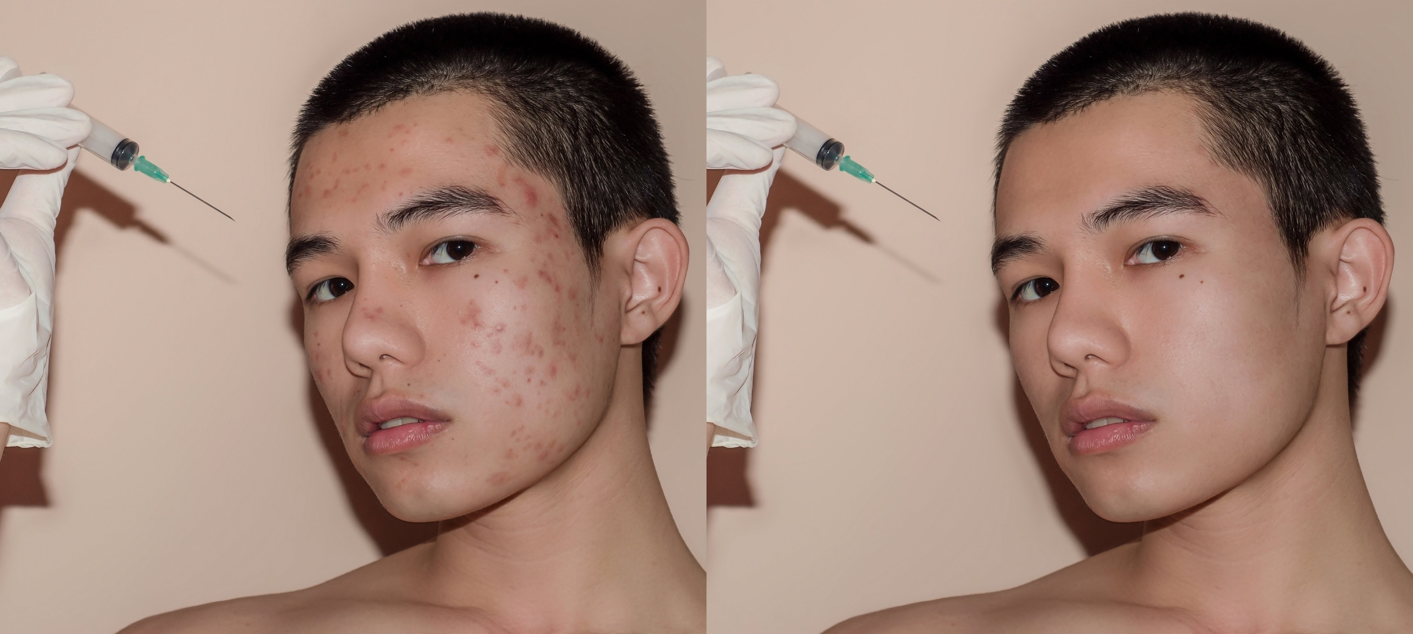 Young man with before and after treatment from acne and pimple by removal acne.