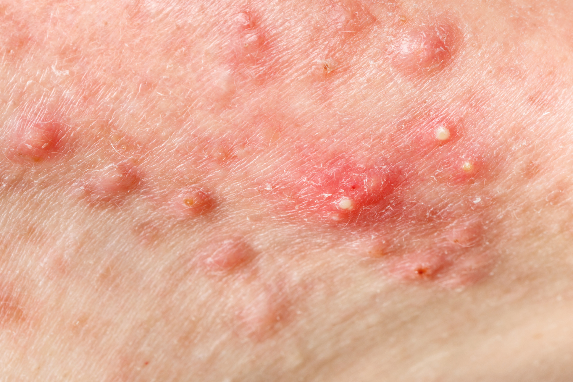 Nodular Cystic Acne Skin