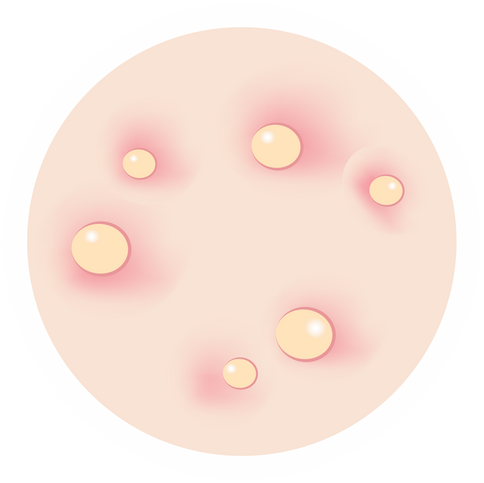 Types of Acne