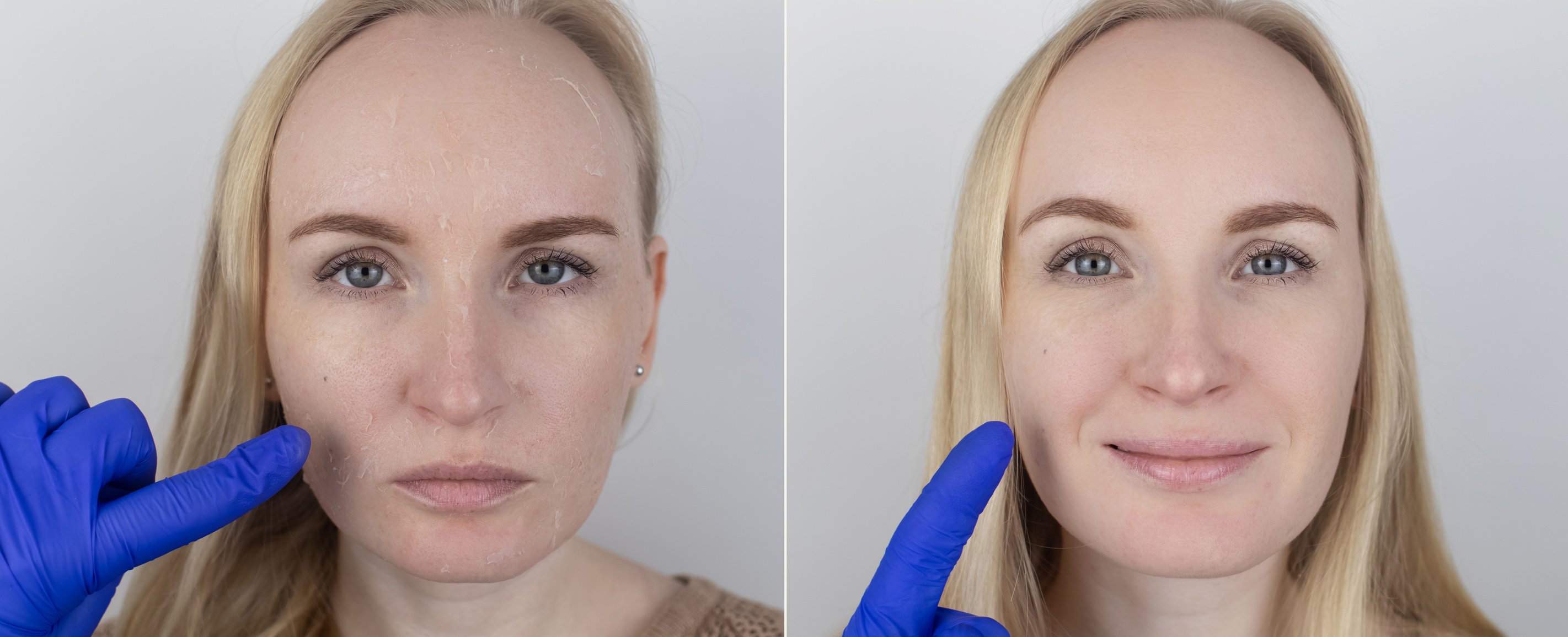 Before and After Dry Skin Treatment 