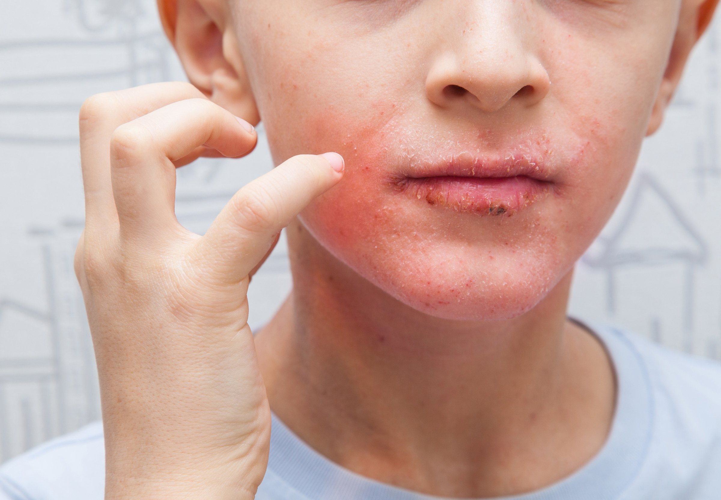 Boy scratching his face. Human skin, presenting an allergic reaction, allergic rash on face and lips.